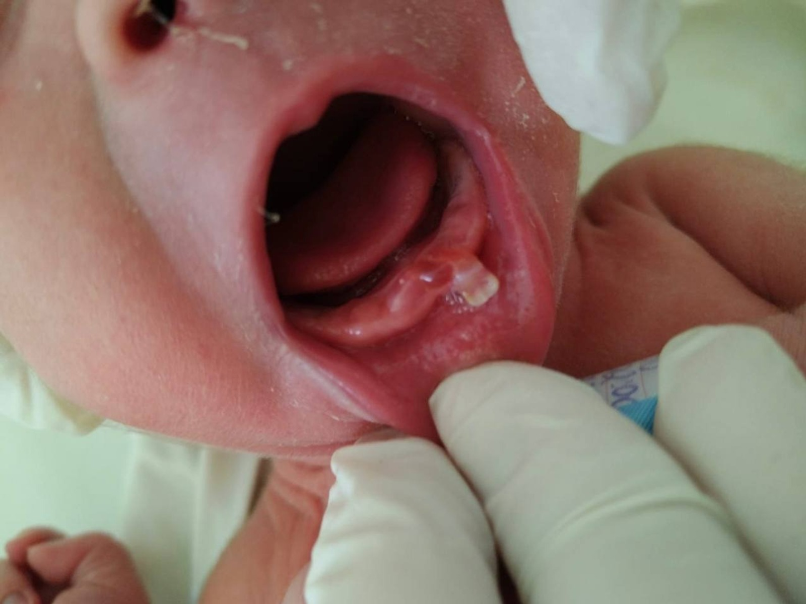 В Башкирии зафиксирован случай появления на свет ребенка с зубами