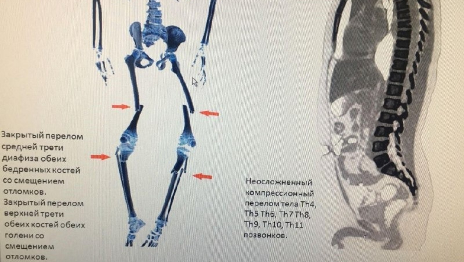 В Башкирии врачи прооперировали 8-летнего ребенка с множественными сложными переломами ног
