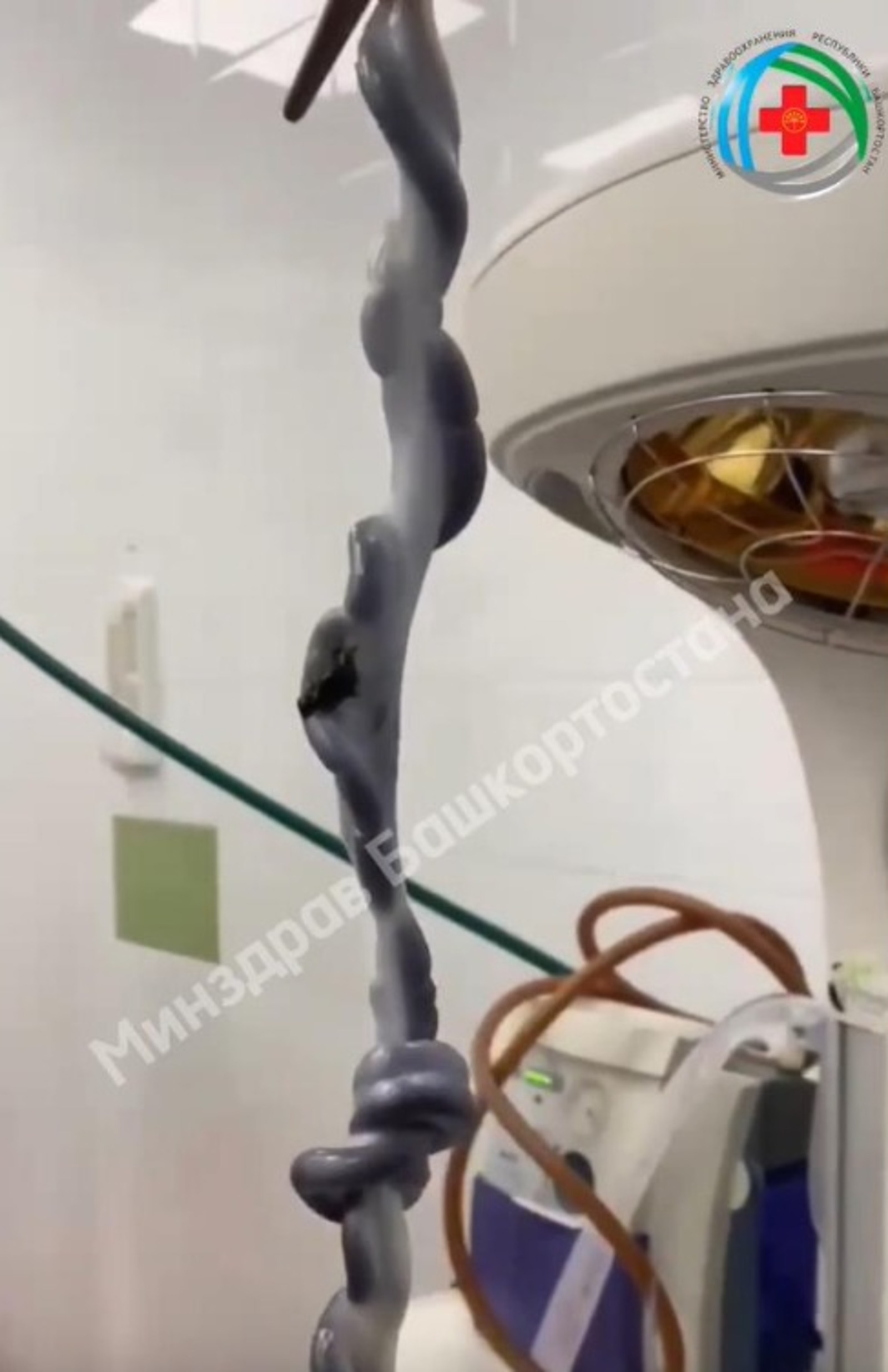 Редкий случай: в Башкирии родился малыш с пуповиной 150 см